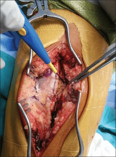 Intraoperative medial parapatellar knee exposure during total knee arthroplasty