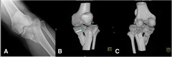 Three-panel imaging of a Schatzker V bicondylar tibial plateau fracture: AP radiograph plus two 3D CT reconstructions.