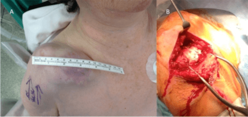Surgical Approaches to Shoulder - intraoperative photographs showing deltopectoral incision and deep shoulder exposure.