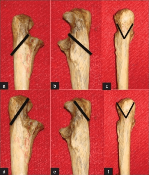 Cadaveric ulna specimens showing olecranon osteotomy line options