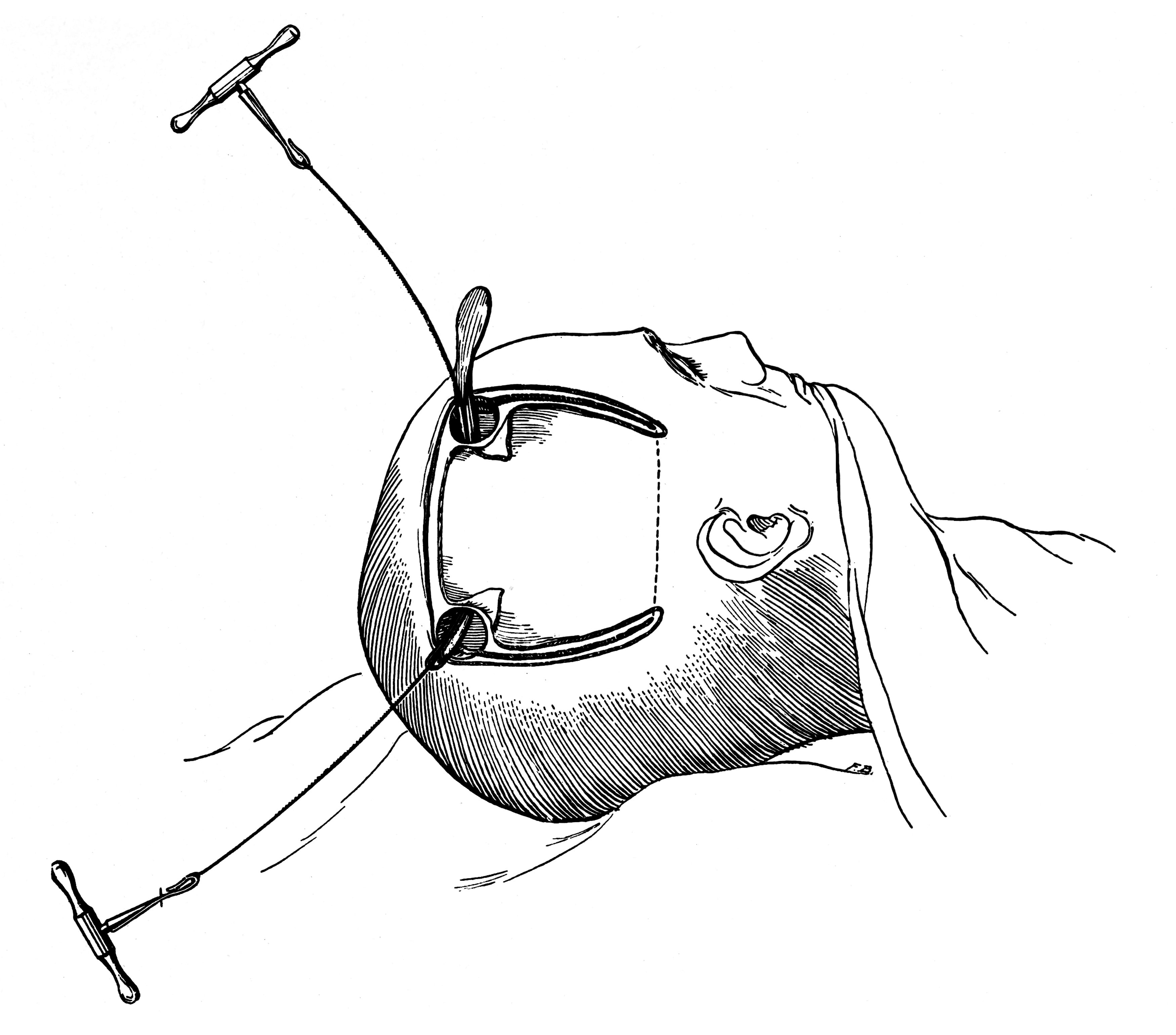Line drawing showing a Gigli wire saw passed around bone and worked with alternating handles.