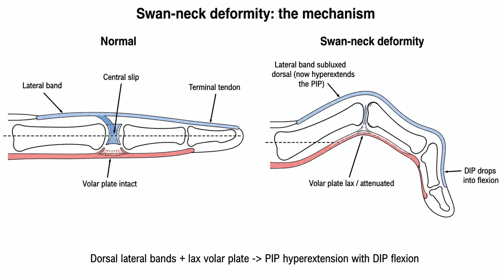 Two-panel sagittal finger diagram contrasting a normal finger with a swan-neck deformity (dorsal lateral band, lax volar plate, PIP hyperextension, DIP flexion)