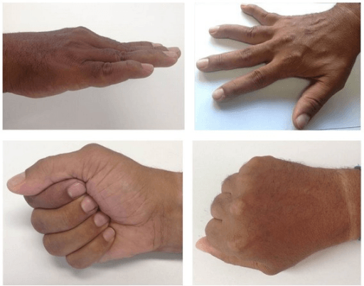 Reversible swan neck deformity demonstrating Nalebuff Type I