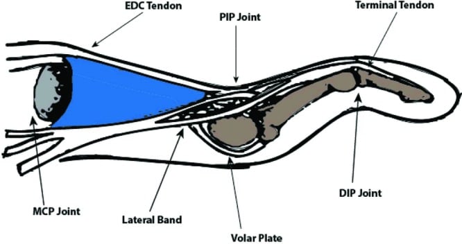 Anatomical diagram of the extensor mechanism and lateral band dorsal subluxation in swan-neck deformity