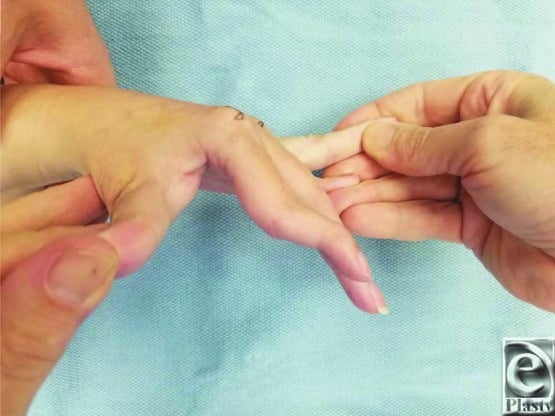 Clinical photograph demonstrating intrinsic tightness examination of the finger
