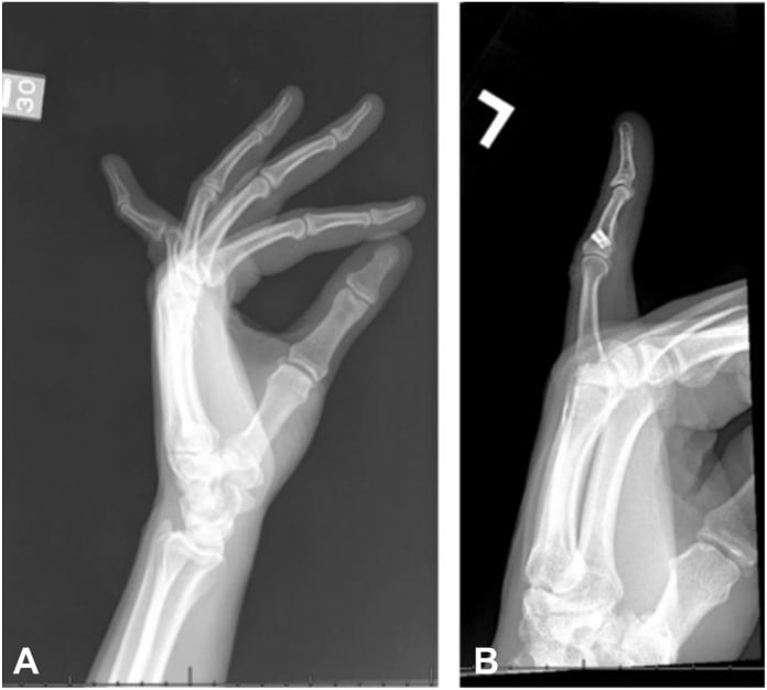 Preoperative and 11-year postoperative lateral radiographs of volar plate reconstruction for swan-neck deformity