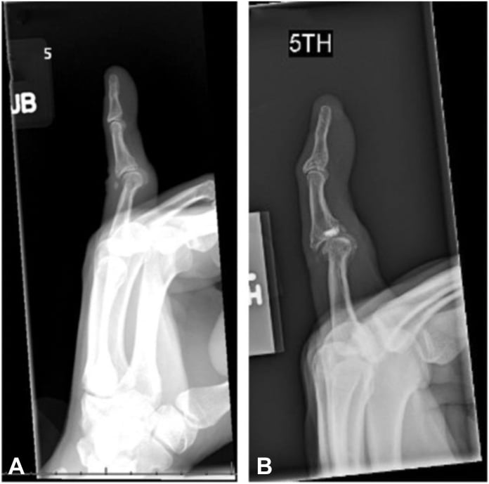 Preoperative and postoperative lateral radiographs of volar plate repair for swan-neck deformity