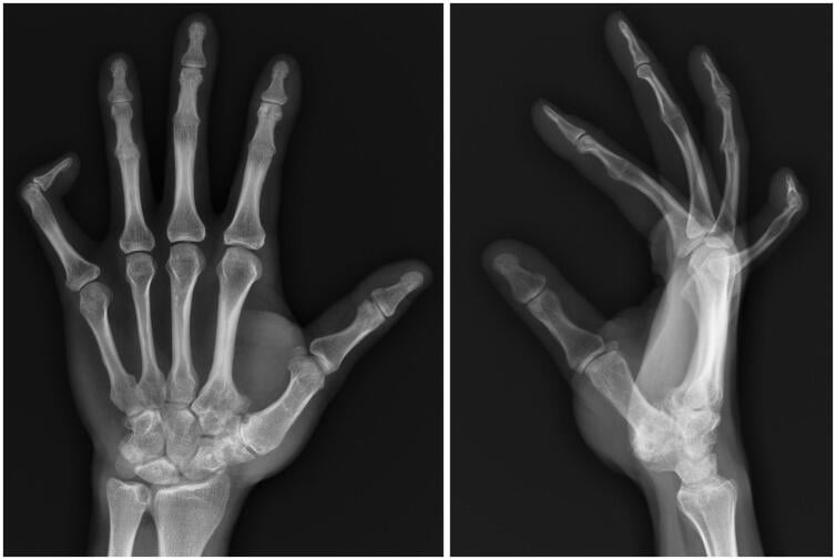PA and oblique hand radiographs showing multi-digit proximal symphalangism