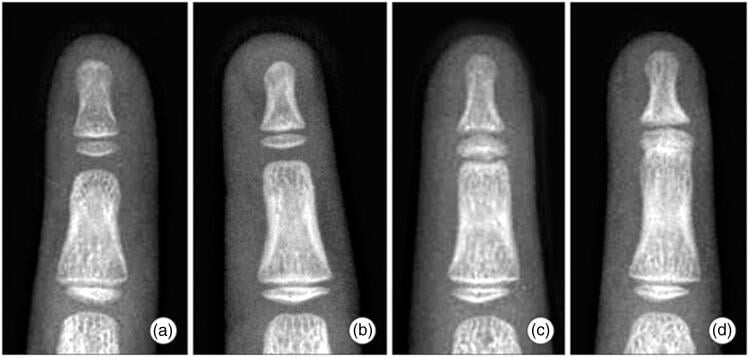 4-panel radiograph series showing progressive grades of symphalangism from normal to bony fusion