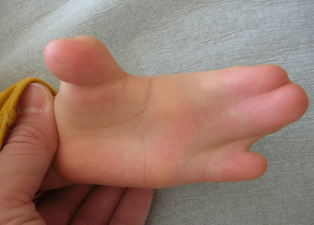 Complex syndactyly of the central digits in Apert syndrome