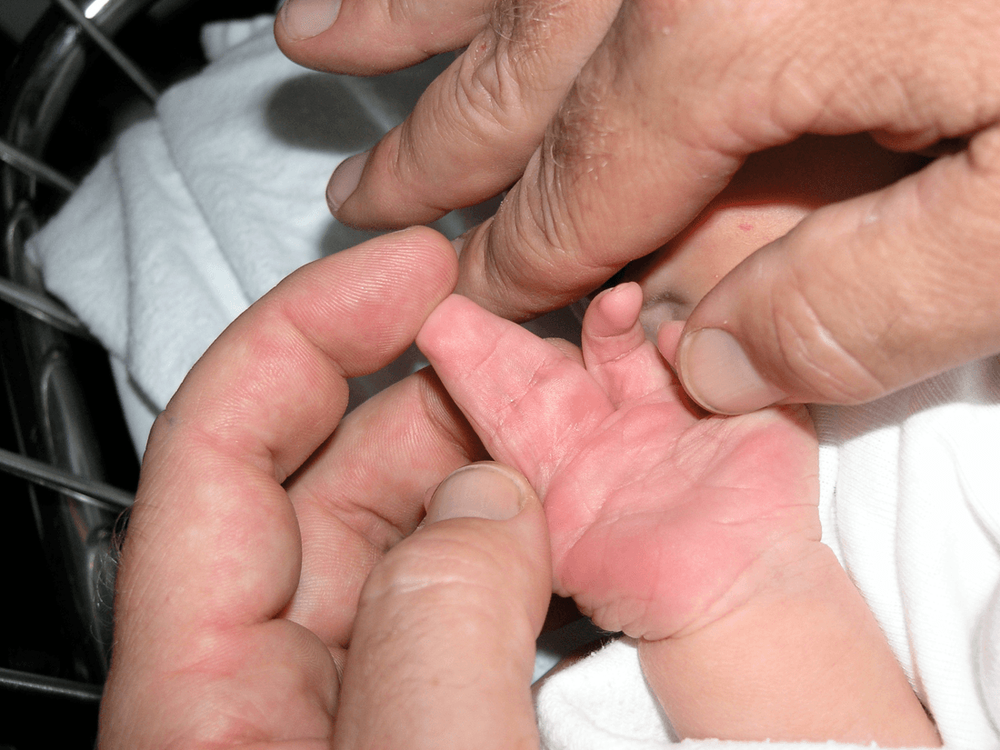 Newborn hand with complete complex syndactyly