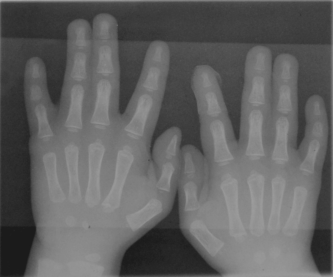Bilateral hand radiographs showing simple syndactyly of the long and ring fingers