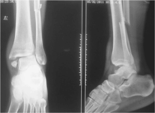 Syndesmotic diastasis on plain radiographs