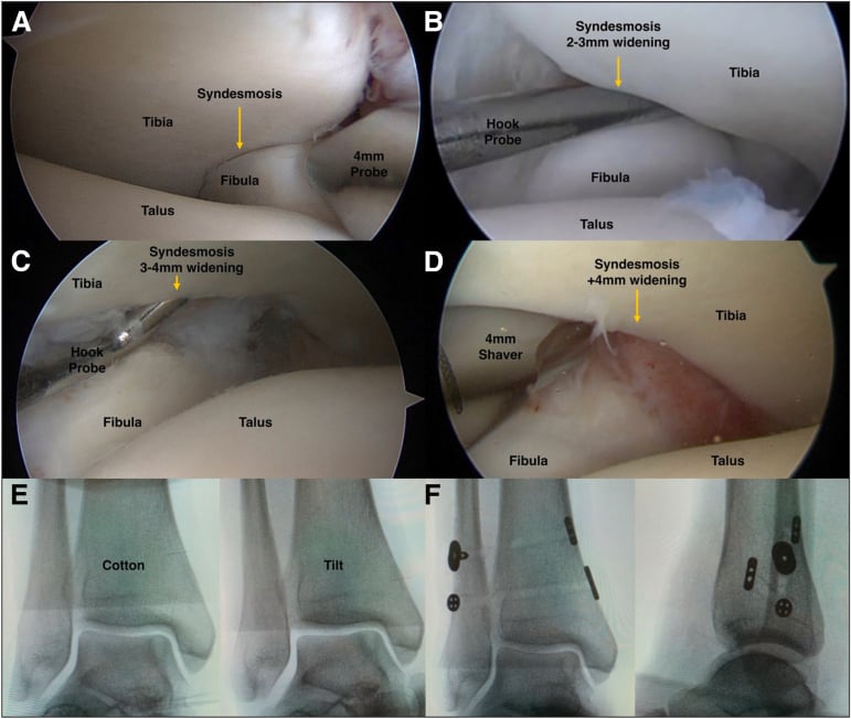 Arthroscopic views through an anteromedial portal showing normal syndesmosis and progressive grades of widening measured against a probe