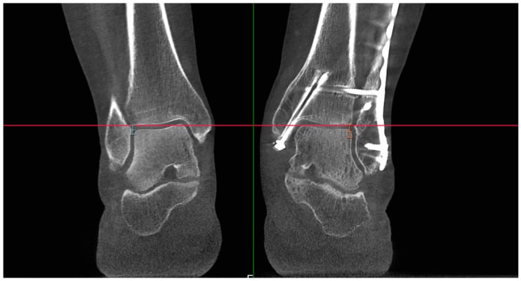 Bilateral axial CT of both ankles aligned at equivalent levels through the tibial plafonds for side-to-side comparison