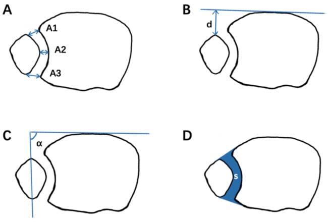 Schematic of axial CT measurements of the syndesmosis including anterior and posterior distances, fibular translation, rotation and area