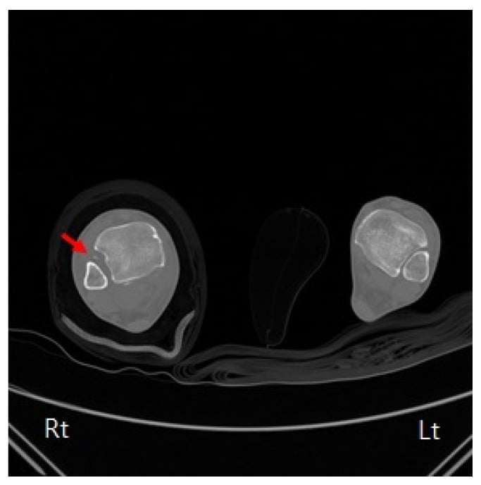 Preoperative axial CT of both ankles showing the fibula displaced out of the fibular notch on the injured side