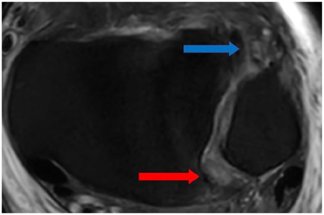 Axial proton density MRI showing complete rupture of the anterior inferior tibiofibular ligament and partial posterior ligament rupture with oedema