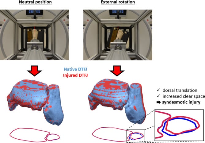 CT of the ankle in neutral and external rotation with three-dimensional overlays of native and injured distal tibiofibular joint position