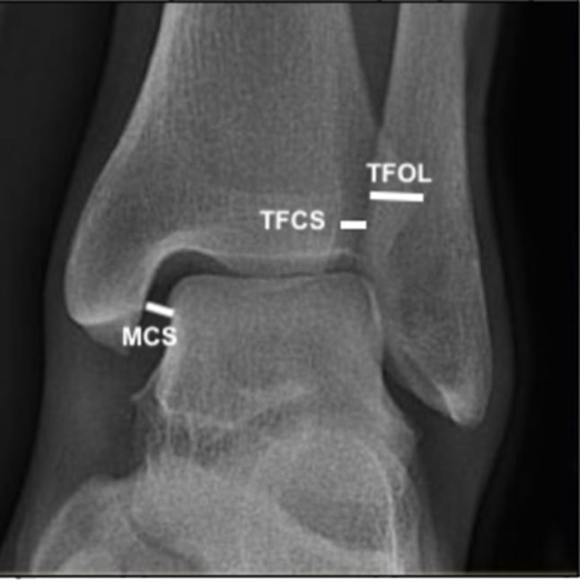 AP ankle radiograph annotated with tibiofibular clear space, tibiofibular overlap and medial clear space