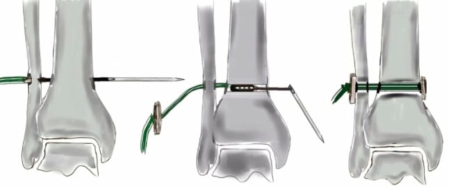 Illustration of the sequence of suture-button insertion across the syndesmosis from drilling to button seating