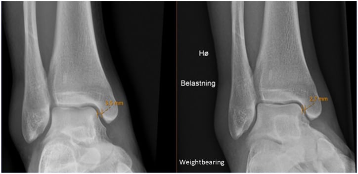 Nonweightbearing and weightbearing mortise radiographs of the same ankle showing a difference in medial clear space