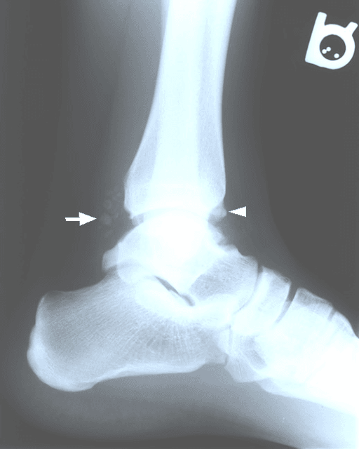 Lateral ankle radiograph showing small calcified loose bodies anterior and posterior to the tibiotalar joint