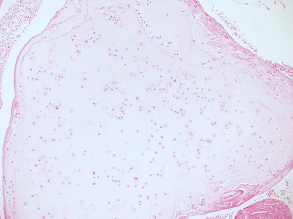 Histology showing mature cartilage arising in synovium with foci of endochondral ossification