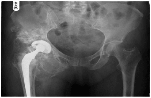 AP pelvis radiograph with right hip prosthesis and aggressive calcified mass around the hip