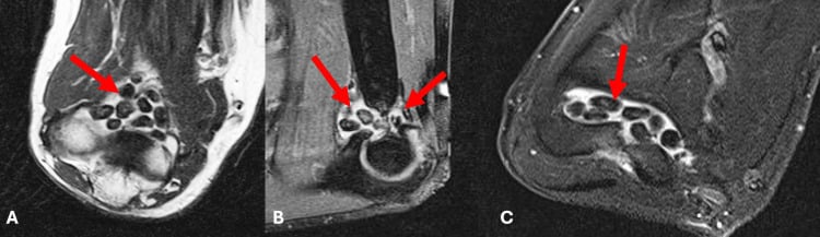 Coronal sagittal and axial elbow MRI showing multiple intra-articular loose bodies