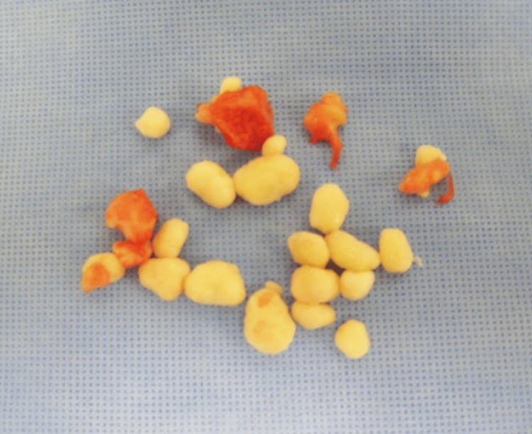 Multiple smooth pearly-white cartilage bodies excised from an elbow joint