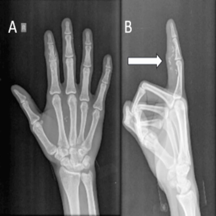 Anteroposterior and lateral hand radiographs showing a soft-tissue mass around the index finger and palm without bone destruction