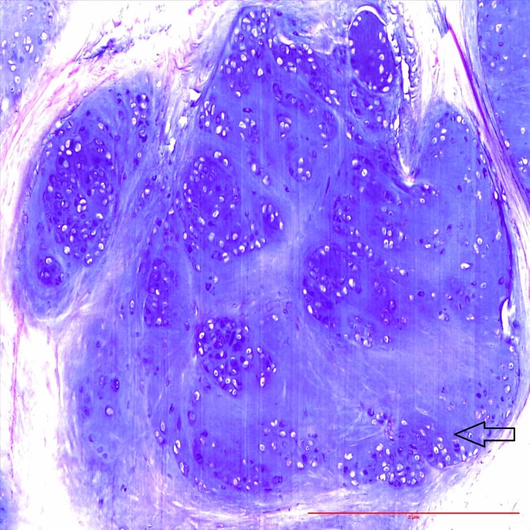 Haematoxylin and eosin section showing lobules of mature hyaline cartilage without cytological atypia