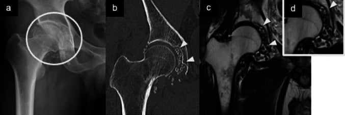 Hip radiograph CT and MRI showing multiple mineralised bodies with central marrow signal