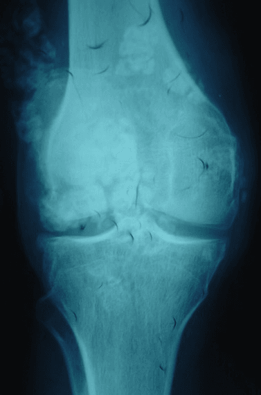 AP knee radiograph showing numerous calcified loose bodies around the joint