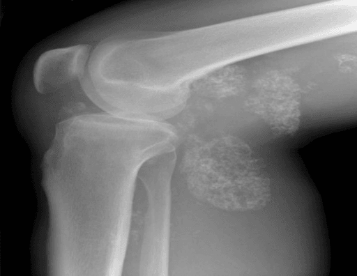Lateral knee radiograph showing lobulated ring-and-arc calcified masses extending into the popliteal region