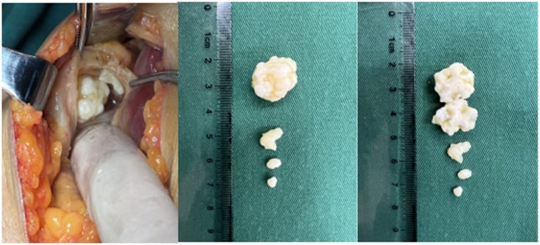 Open posterior knee exposure showing a popliteal cyst containing cartilaginous nodules and a bisected dominant nodule