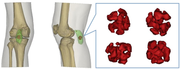 Three-dimensional CT reconstruction showing a popliteal cyst and the cartilaginous nodule within it