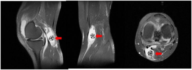 Sagittal T2 knee MRI showing a coral-like cartilaginous nodule within a fluid-filled popliteal cyst