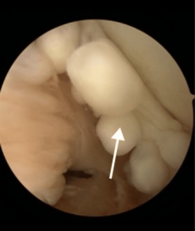 Arthroscopic shoulder views showing multiple white cartilaginous nodules within the glenohumeral joint