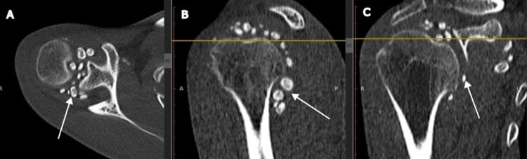 Axial sagittal and coronal CT showing multiple calcified loose bodies in the shoulder joint
