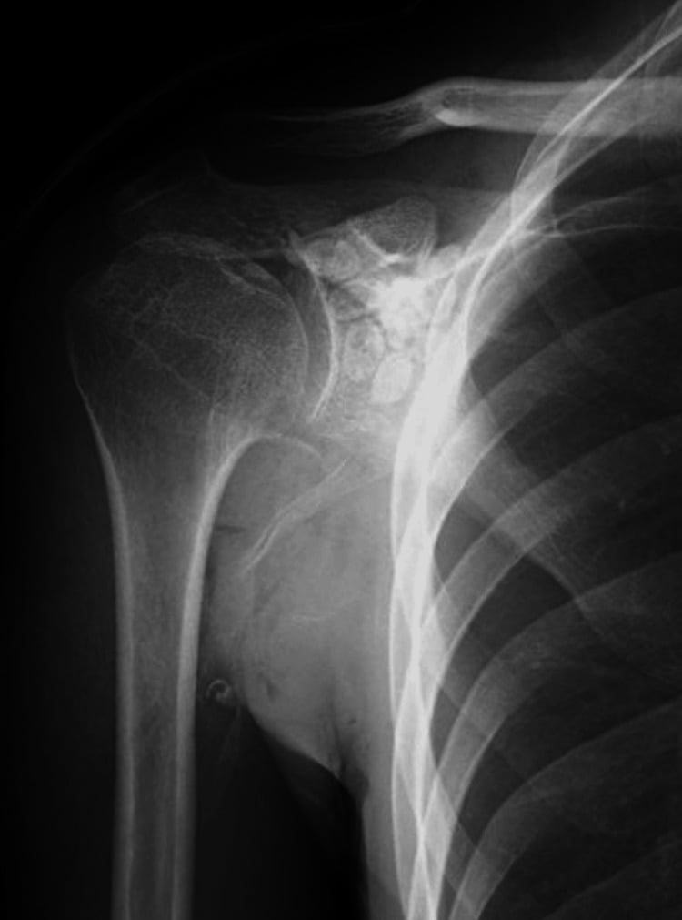 Postoperative shoulder radiograph showing clearance of the previously calcified loose bodies