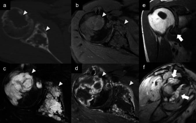 CT and MRI of the shoulder showing destructive synovial chondrosarcoma invading the humeral head and scapula