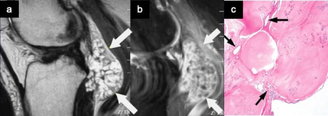 Knee MRI showing a lobulated non-mineralised synovial mass with corresponding hyaline-cartilage histology