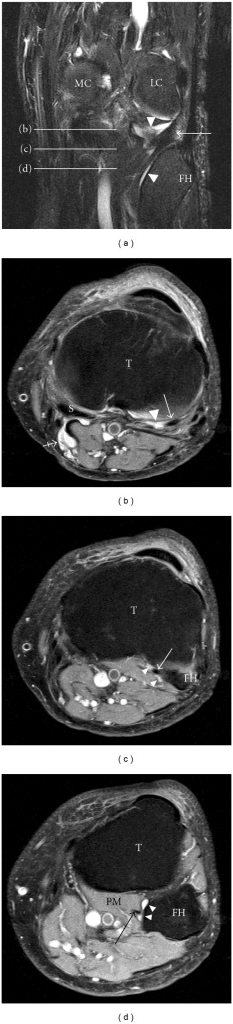 Knee MRI showing the synovial recess along the popliteus tendon at three axial levels, with a coronal overview labelling the femoral condyles and fibular head