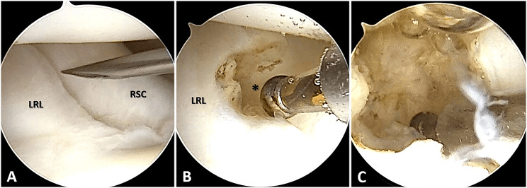 Three arthroscopic panels, A to C: an instrument in the interval between the LRL and RSC ligaments, a shaver entering beside LRL at the asterisk, and the resected cavity