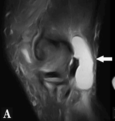 Sagittal knee MRI, panel A, with an arrow on a lobulated high-signal cyst in the popliteal fossa