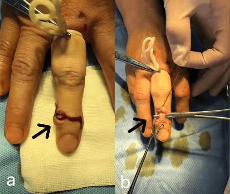 Two operative photographs, a and b: a curved dorsal incision over the DIP joint (arrow) and dissection at the joint with forceps (arrow)