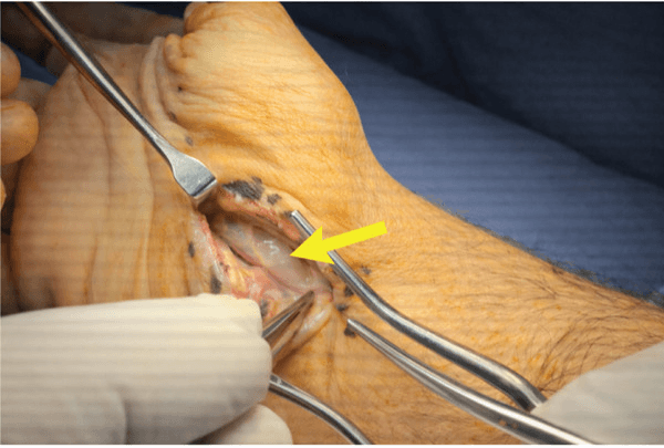 Open volar wrist exposure with a yellow arrow on a deep ganglion between the flexor digitorum profundus tendons