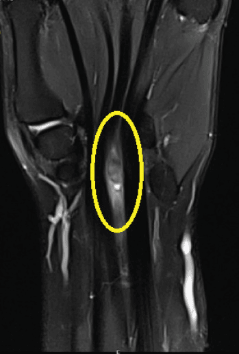 Long-axis wrist MRI with a yellow ellipse around an elongated high-signal ganglion in the flexor-tendon compartment